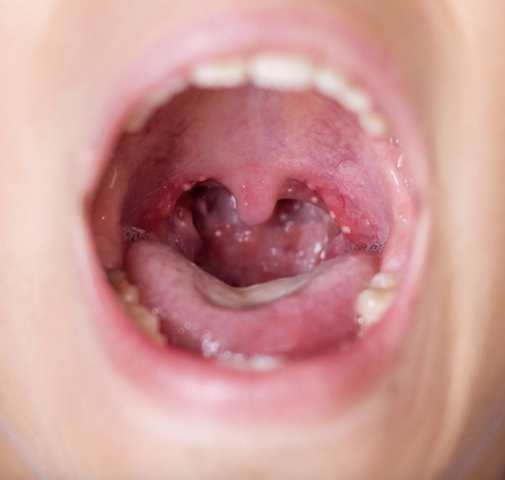 Image of tonsils with signs of infection.